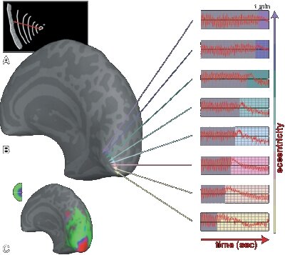 Migraine study with functional Magnetic Resonanz Imaging