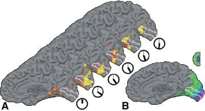 Migraine study with functional Magnetic Resonanz Imaging